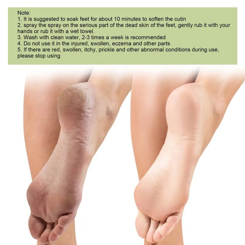 Foot Care Spray Citrus Heel Elbow Knee Exfoliating Anti-Drying Crack Peeling Removal Dead Skin Calluses Hand Feet Repair Liquid